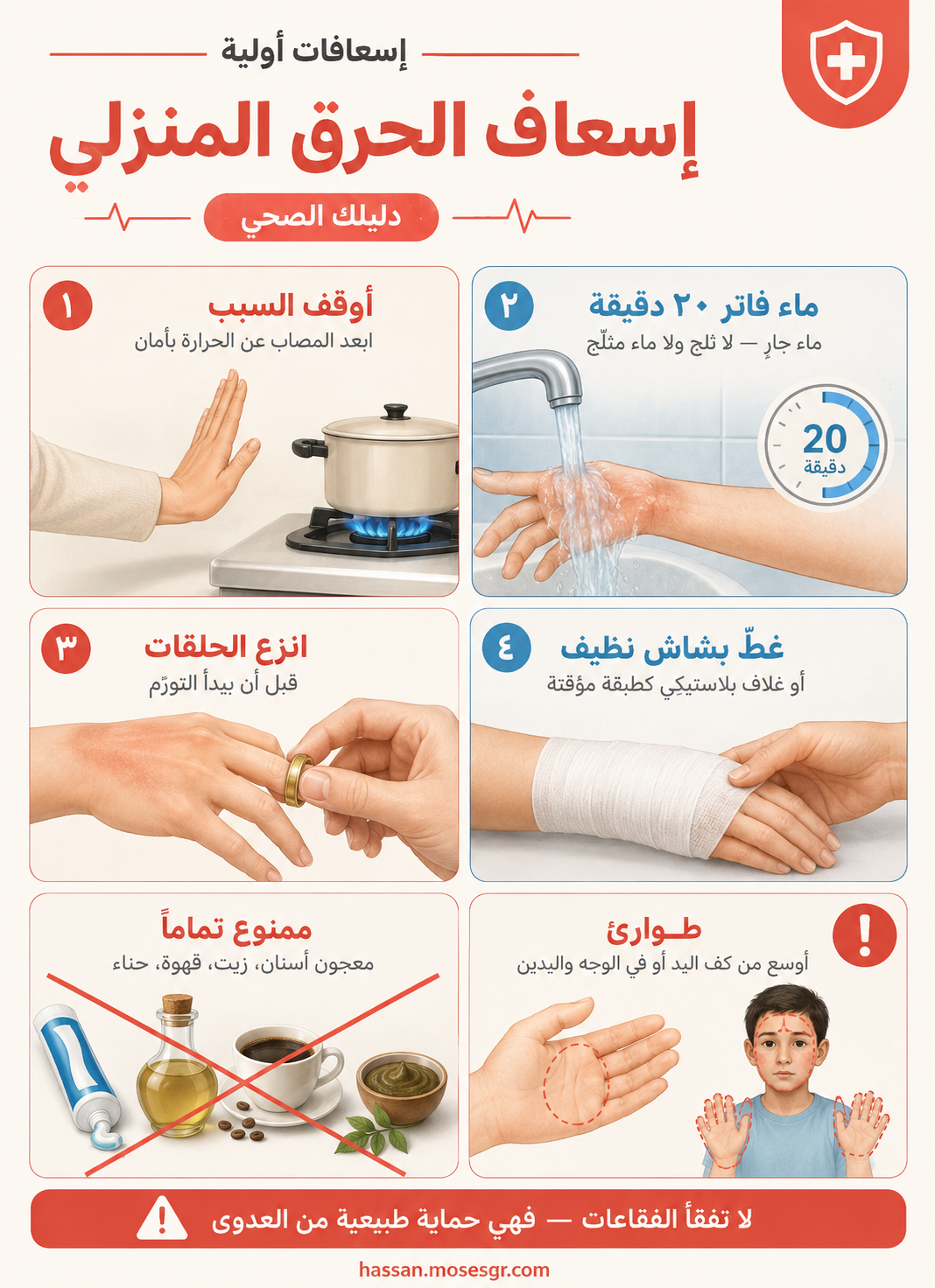 إسعاف الحرق المنزلي